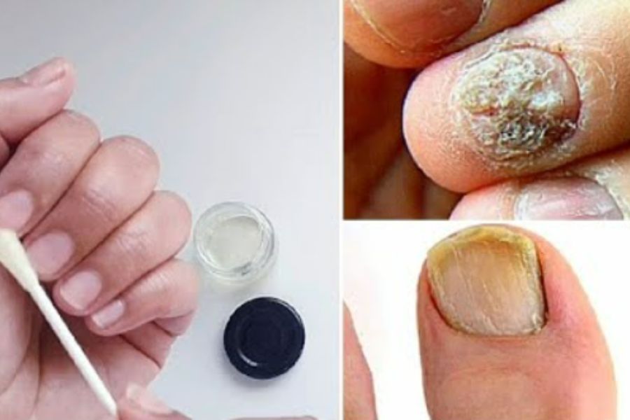 como eliminar hongos en las uñas de las manos