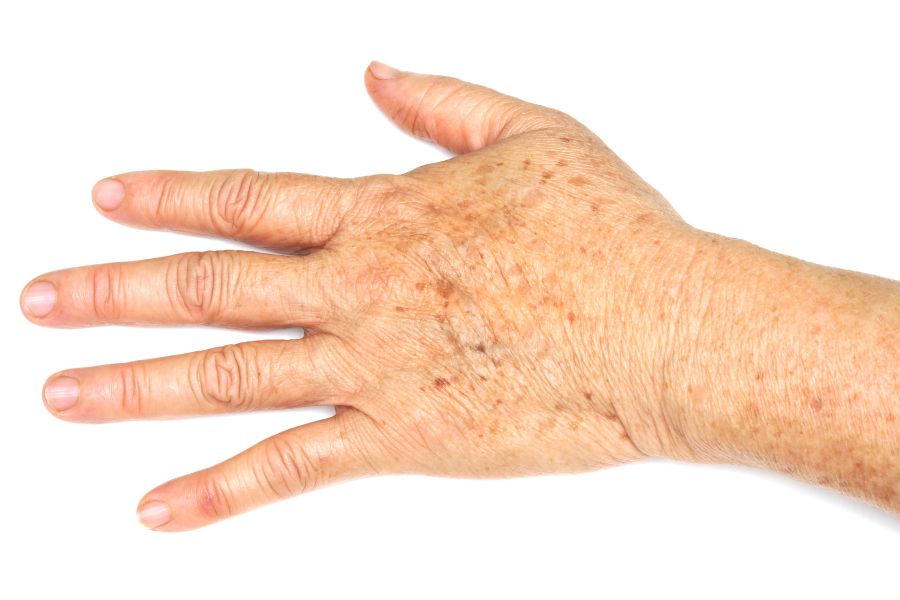 cómo quitar las manchas de las manos con remedios caseros